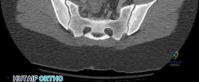 Illustration 190 for OrthoCash: Trauma MCQs & Cases for a yearold woman