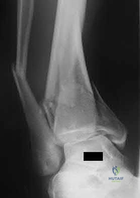 Illustration 95 for OrthoCash: Trauma MCQs & Cases for a yearold woman