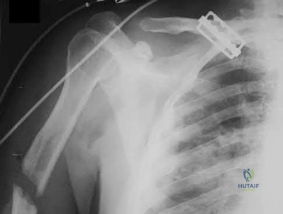 Illustration 133 for OrthoCash: Trauma MCQs & Cases for a yearold woman