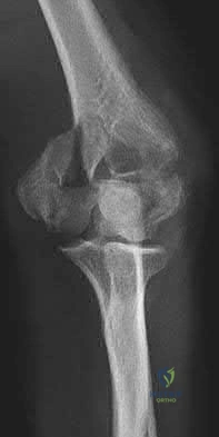 Illustration 72 for OrthoCash: Trauma MCQs & Cases for a yearold woman