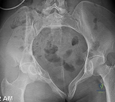 Illustration 135 for OrthoCash: Trauma MCQs & Cases for a yearold woman