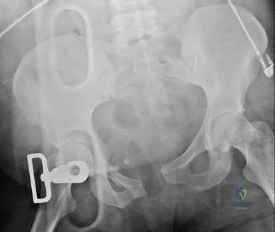 Illustration 129 for OrthoCash: Trauma MCQs & Cases for a yearold woman