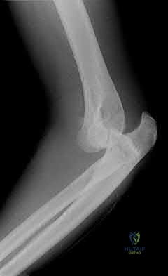 Illustration 167 for OrthoCash: Trauma MCQs & Cases for a yearold woman