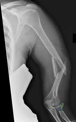Illustration 178 for OrthoCash: Trauma MCQs & Cases for a yearold woman