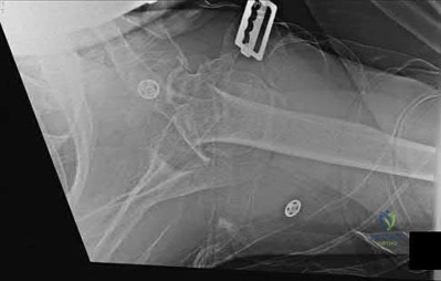 Illustration 210 for OrthoCash: Trauma MCQs & Cases for a yearold woman