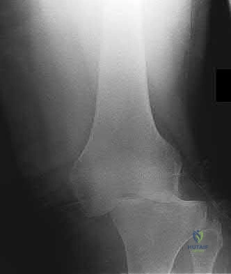 Illustration 162 for OrthoCash: Trauma MCQs & Cases for a yearold woman