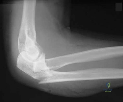 Illustration 30 for OrthoCash: Trauma MCQs & Cases for a yearold woman