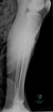 Illustration 171 for OrthoCash: Trauma MCQs & Cases for a yearold woman