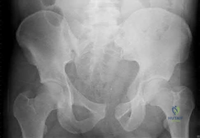 Illustration 175 for OrthoCash: Trauma MCQs & Cases for a yearold woman