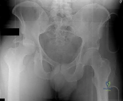 Illustration 153 for OrthoCash: Trauma MCQs & Cases for a yearold woman