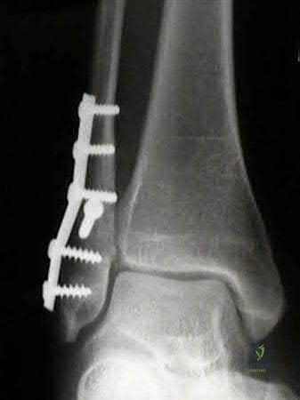 Maximize Osteosarcoma Survival: Chemotherapy Surgical Excision