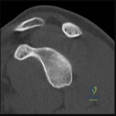 Orthopedic Shoulder And Review | Dr Hutaif Shoulder & E -...