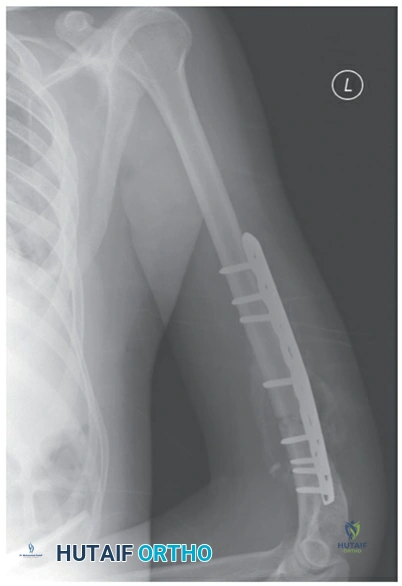 Plate and screw fixation of a distal third humeral shaft fracture.