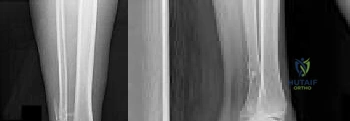 Test Your Orthopedic Skills: Motor Vehicle Collision Trauma MCQs