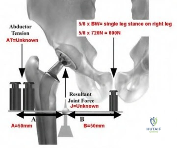 Illustration of total knee replacement tkr - Dr. Mohammed Hutaif