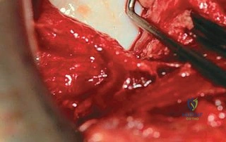 صورة شعاعية بعد التثبيت