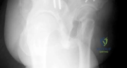 Periacetabular Osteotomy: End Hip Pain, Improve Flexion and Internal Motion
