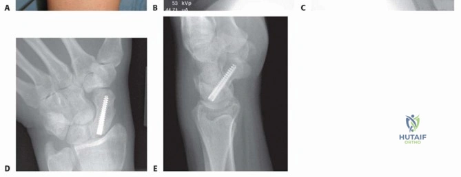 A1 Coccygeal/sacral compression or ligamentous avulsion fractures