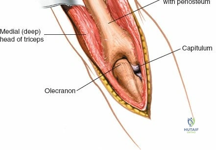 Illustration of humerus posterior approach - Dr. Mohammed Hutaif