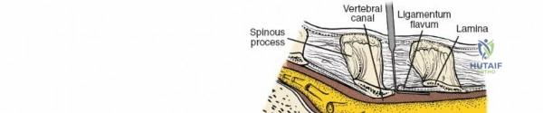 Illustration of spine posterior approach - Dr. Mohammed Hutaif