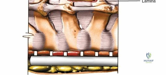 Mastering the Posterior Approach to the Subaxial Cervical Spine