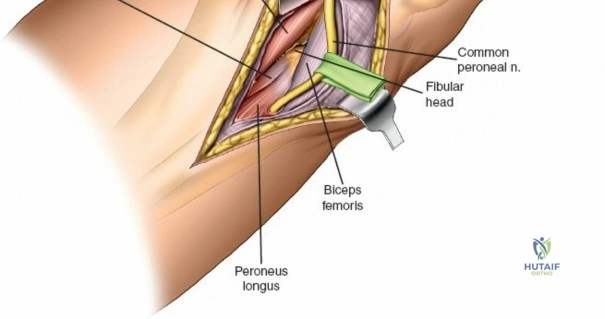 Figure 4: Diagram illustrating the specific area of bone exposed by the posterolateral approach, often necessitating a buttress plate.