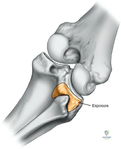 Figure 8: Incision marking on the posterolateral aspect of the knee.