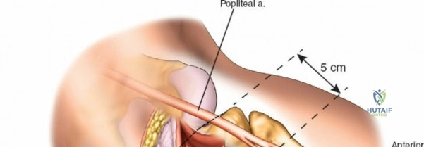 Figure 15: Placement of a pre-contoured posterolateral locking plate.