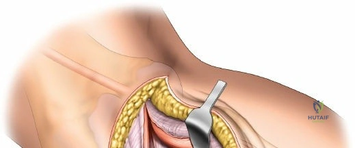 Figure 12: Exposure of the posterolateral knee capsule and underlying bone.