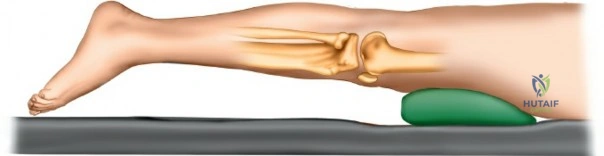 Figure 24: Diagram illustrating Luo's three-column classification of tibial plateau fractures.