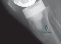 Arab Orthopaedic Board MCQs - Part 23
