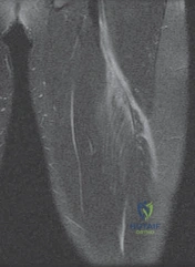 Illustration of proximal hamstring injury - Dr. Mohammed Hutaif