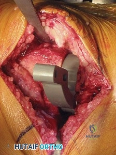 صورة توضيحية لـ استبدال مفصل الركبة الكلي المثبت خلفياً (PS TKA): دليل شامل لنجاح الجراحة والتعافي