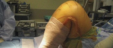 صورة توضيحية لـ استبدال مفصل الركبة الكلي المثبت خلفياً (PS TKA): دليل شامل لنجاح الجراحة والتعافي