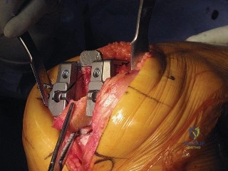 صورة توضيحية لـ استبدال مفصل الركبة الكلي المثبت خلفياً (PS TKA): دليل شامل لنجاح الجراحة والتعافي
