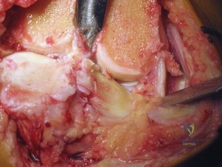 صورة توضيحية لـ استبدال مفصل الركبة الكلي المثبت خلفياً (PS TKA): دليل شامل لنجاح الجراحة والتعافي