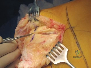 تقنيات جراحة العظام الحديثة