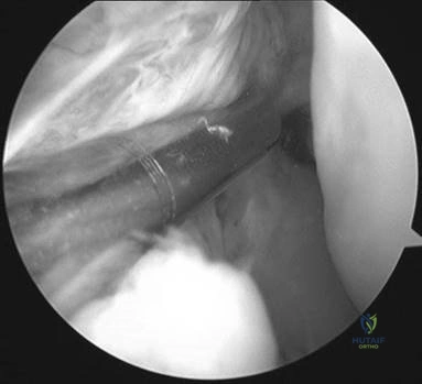 Illustration 10 for Ace FRCS Orthopaedics: Oxford University Press Adult Pathology Viva