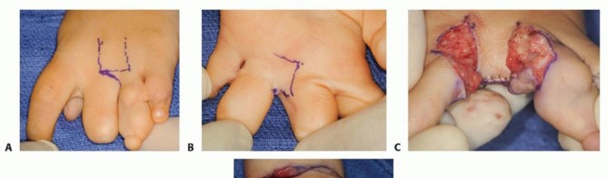  Amniotic Band Syndrome