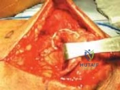 Illustration of chronic quadriceps tendon ruptures - Dr. Mohammed Hutaif