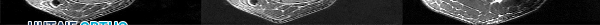 Retrograde Intramedullary Nailing of the Femur