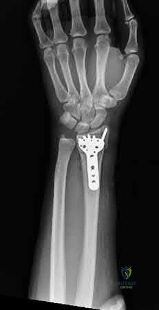 Retrograde Intramedullary Nailing of the Femur FRACTUREs
