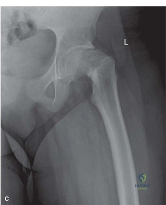 Comprehensive Guide to Slipped Capital Femoral Epiphysis (SCFE): Epidemiology, Biomechanics, and Management