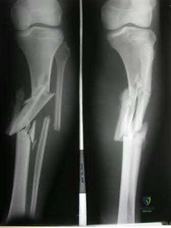 Illustration 213 for OrthoCash: Trauma MCQs & Cases for a yearold woman
