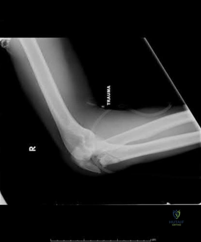 Illustration 215 for OrthoCash: Trauma MCQs & Cases for a yearold woman