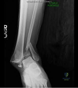 Illustration 222 for OrthoCash: Trauma MCQs & Cases for a yearold woman
