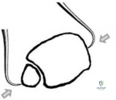 Illustration 227 for OrthoCash: Trauma MCQs & Cases for a yearold woman