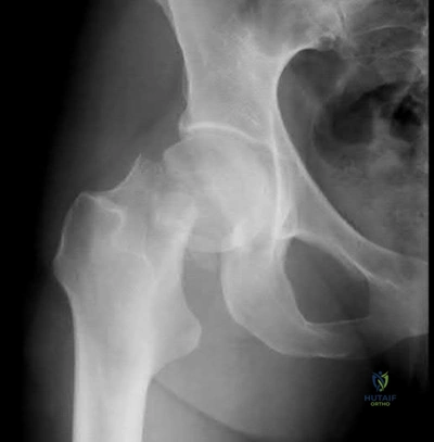 Illustration 229 for OrthoCash: Trauma MCQs & Cases for a yearold woman