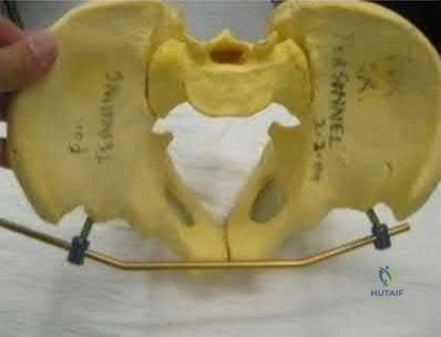 Illustration 233 for OrthoCash: Trauma MCQs & Cases for a yearold woman