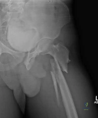 Illustration 243 for OrthoCash: Trauma MCQs & Cases for a yearold woman